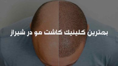 بهترین کلینیک کاشت مو در شیراز