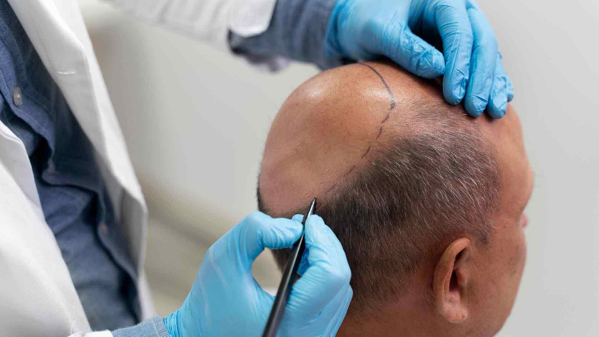 بهترین کلینیک کاشت مو در شیراز